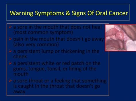 Oral Cancer