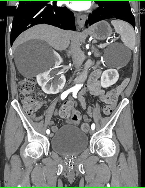 Bosniak Cyst