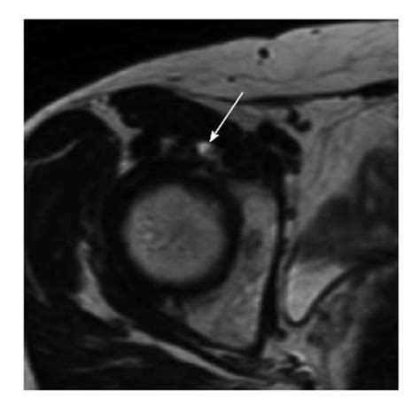 Cystic Lesion Around The Hip Joint