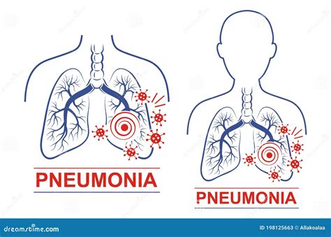 Pneumonia Disease Vector Icon Set Human Lungs Trachea Anatomy