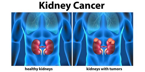 Knowing About Kidney Cancer Renal Cancer Gauri Urogynecology Clinic