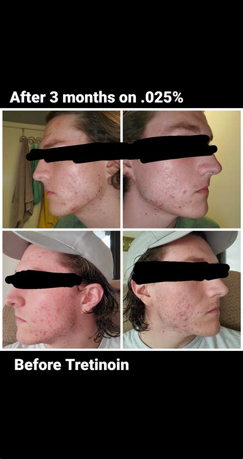 Before And After 3 Months In On Tret Rtretinoin