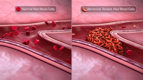 Sickle Cell Disease Origin Manifestation And Management Scientific