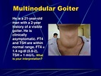 PPT - Simple (Nontoxic) Goiter: Diffuse and Multinodular PowerPoint ...