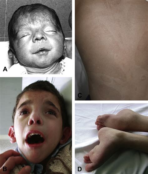 Figure 1 From Patau Syndrome With Long Survival In A Case Of Unusual Mosaic Trisomy 13
