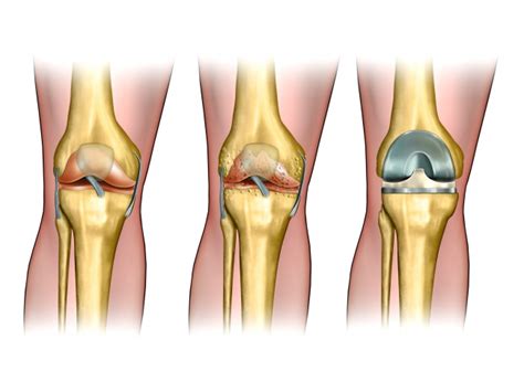 Cemented and Cementless Knee Replacement | Knee Replacement Surgery in
