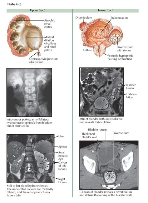 Obstructive Uropathy Pediagenosis