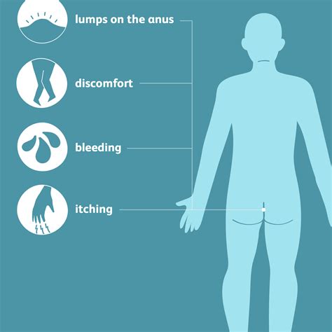 Prolapsed Hemorrhoids Symptoms Causes And Treatment