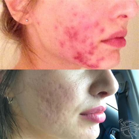 This Girl Developed Severe Cystic Acne That Left Her Face Permanently