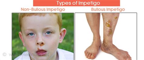 Impetigo Symptoms Causes Complications Diagnosis Treatment