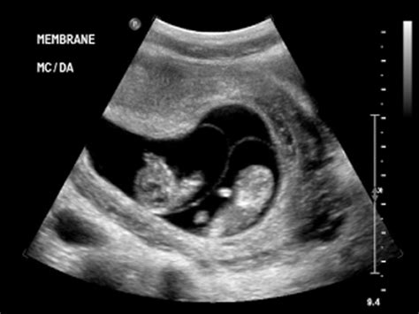 Early Twin Pregnancy Ultrasound