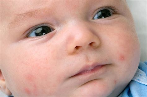 3.0 kesan masalah pembuangan bayi pembuangan bayi pada hari ini telah memberi kesan dan impak yang begitu besardalam masyarakat. 5 Langkah Tepat Mengatasi Eczema Pada Bayi - Semua Halaman ...