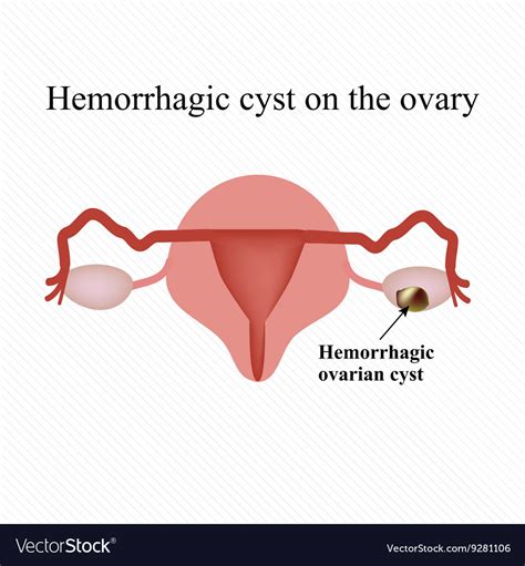 Hemorrhagic Ovarian Cyst Ovarian Cyst Ovarian Disease Ovarian Hot Sex Picture