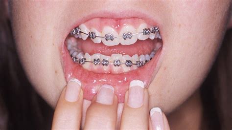 Adult Braces Why Are More Grown Ups Getting Their Teeth Straightened