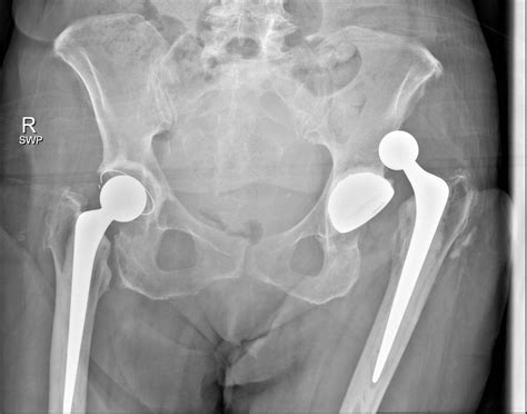 An Unusual Complication Of Hip Dislocation After Total Hip Replacement Eurorad