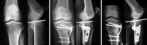 The Effect Of Closed And Open Wedge High Tibial Osteotomy On Tibial