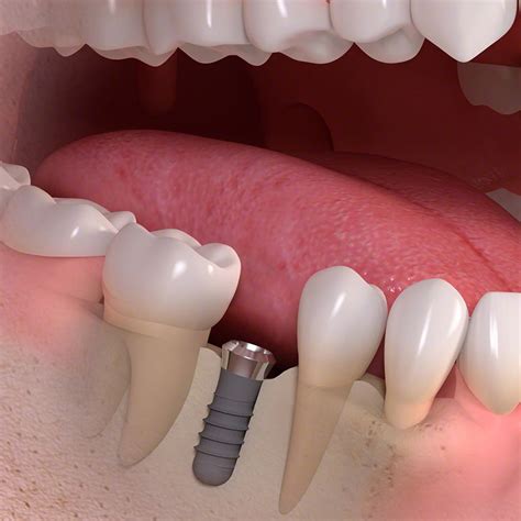 Lista Foto Fotos De Implantes Dentales Mal Colocados Cena Hermosa