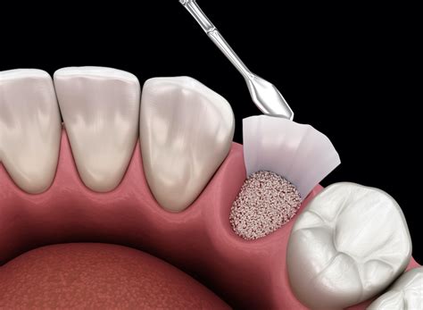 Bone Grafting Midwest Oral Surgery