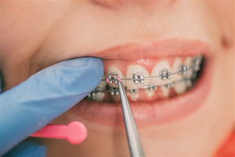 7 Pros And Cons Of Wearing Orthodontic Braces