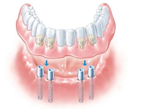 A Dental Implant Is An Artificial Root That Is Surgically Placed Within