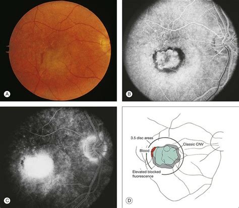 Neovascular Exudative Or Wet Age Related Macular Degeneration