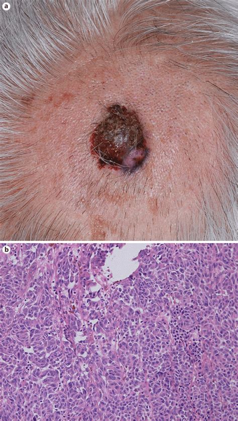 A A Red Brown Dome Shaped Nodule On The Scalp B Dense Infiltration Of