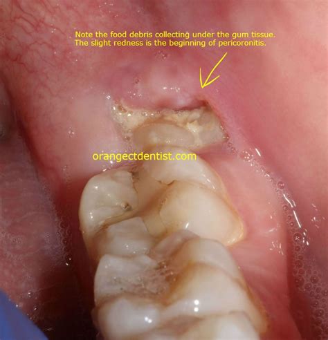 How Long Do Wisdom Teeth Extractions Take To Heal