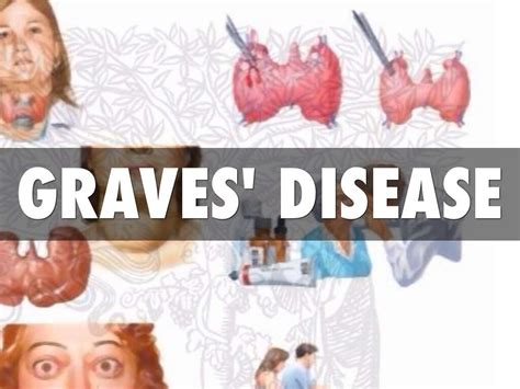 Graves Disease 10 Graves Disease Symptoms
