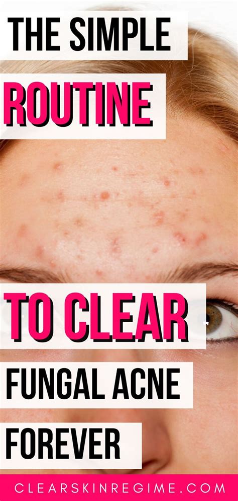 How To Clear Fungal Acne Aka Little Forehead Bumps Clearskinregime In