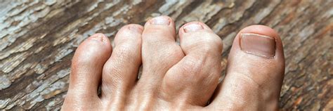 Common Toe Deformities Truortho Orthopaedic Specialists