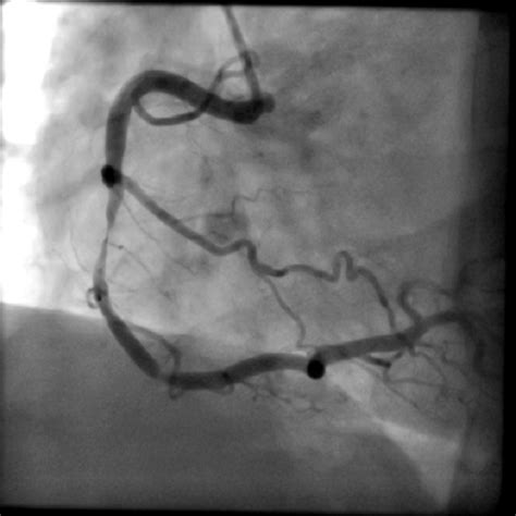 Coronary Angiography Concord Cardiology