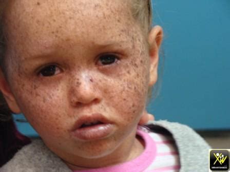 Xeroderma pigmentosum (xp) is a genetic disorder in which there is a decreased ability to repair dna damage such as that caused xeroderma pigmentosum complementation group a/b/c/d/e/f/g 3. Xeroderma Pigmentosum. - DermatoMaroc