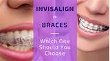 Invisalign Tmj Treatment Pictures