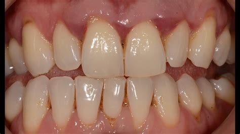 Treatment Of Advanced Periodontal Gum Disease With Non Surgical And