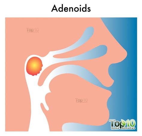 Adenoids Diagram