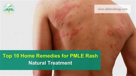 Top 10 Home Remedies For Pmle Rash Natural Treatment