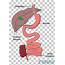 Duodenal Switch Bariatric Surgery Duodenum Gastric Bypass PNG 