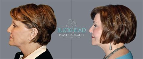 Brow Lift Buckhead Plastic Surgery Atlanta Ga