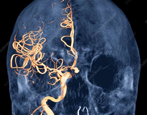 Carotid Aneurysm Angiogram Stock Image M Science Photo Library