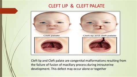 Cleft Lip Palate 05f
