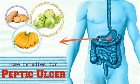 Home Remedy Treatment For Gastric Ulcers Homemade Ftempo