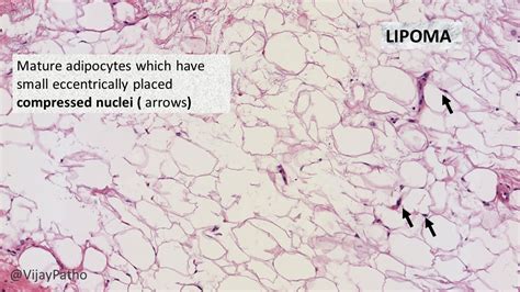 Pathology Of Lipoma Pathology Made Simple
