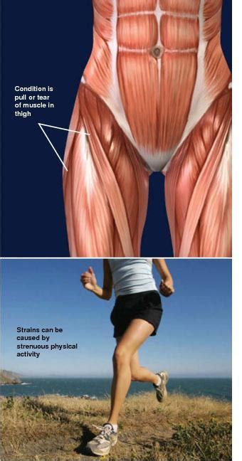 Muscle Strain Injuries Of The Thigh Sarasota Fl Schofield Hand And Bright Orthopaedics