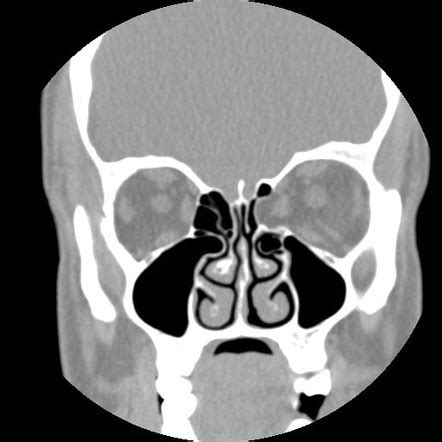 Ethmoid Bulla Radiology Reference Article Radiopaedia Org