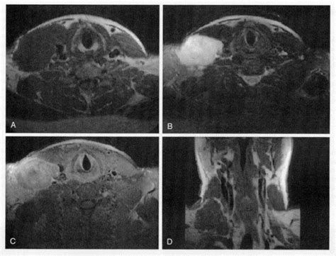 Imaging Of Benign And Malignant Soft Tissue Tumors Of The Neck