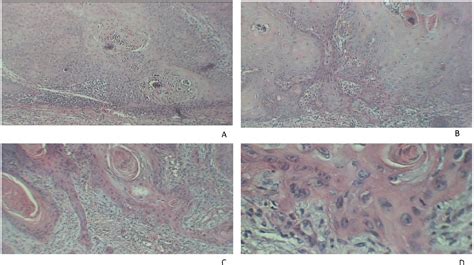 Figure 1 From Serum Sialylation Changes In Actinic Keratosis And