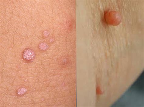 Difference Between Skin Tags And Warts Skin Tag Skin Tag Removal Warts