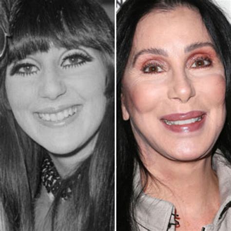 Cher Plastic Surgery Pictures