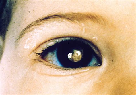 White Spot On Eye Causes Symptoms And Treatment