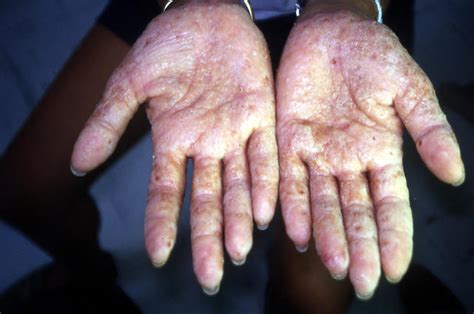 Dermatitis Ekzema Hand Eczema Picture Hellenic Dermatological